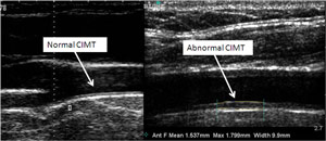 Image result for carotid intima-media thickness